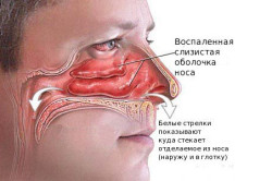 Образование хронического гайморита