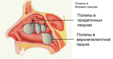 Почему часто закладывает нос без насморка?